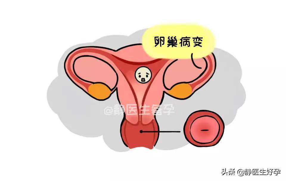 (a)代孕中心那里找,备孕很久却一直怀不上，是排卵障碍吗？